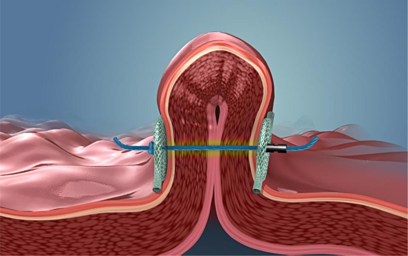 Pose® 2.0 Double Helix
